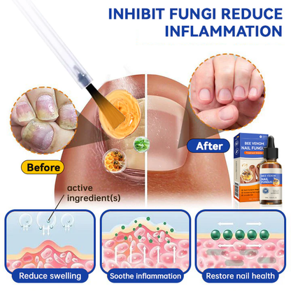 Bee Venom Nail Fungus Treatment Solution